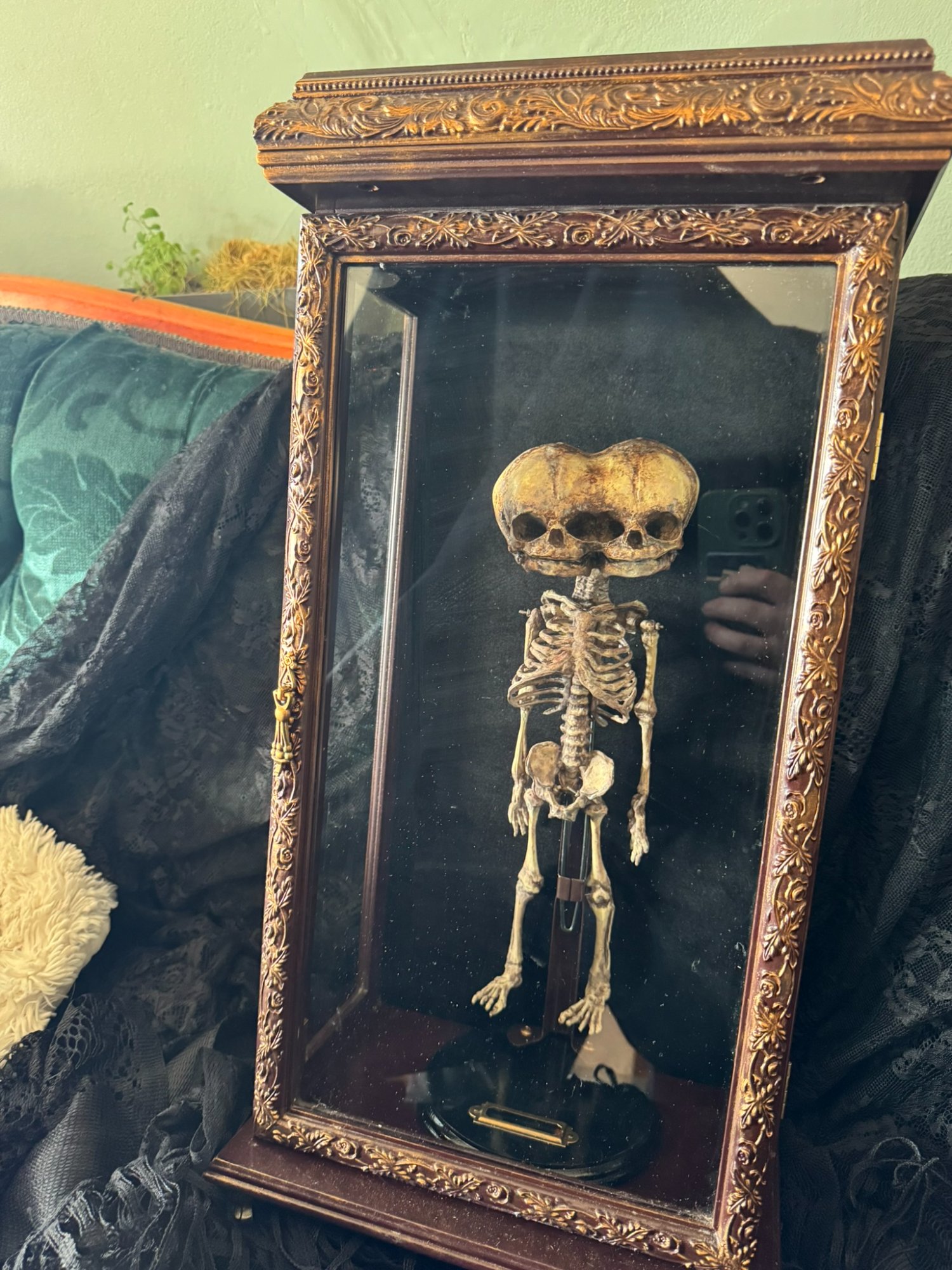 Dicephalic Twin Skeleton